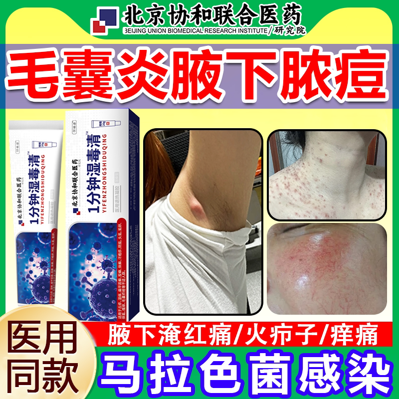 腋下长痘痘毛囊炎马拉色菌脓包腋窝胳肢窝火疖子硬疙瘩拔毒脓膏wg