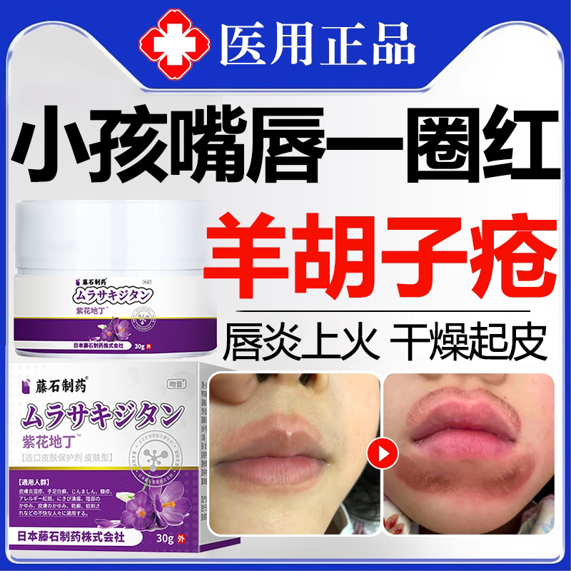 儿童舔嘴唇巴一圈红肿口角唇周炎羊胡子疮干裂脱皮小孩上火唇膏wg
