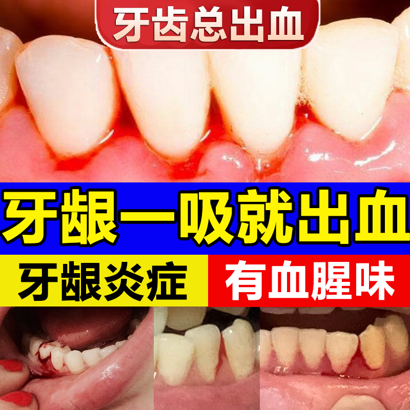牙龈出血牙周炎医用脱敏膏