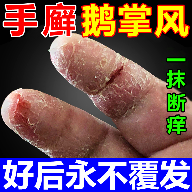 鹅掌风特效药干裂脱皮止痒抑菌膏真菌感染手上小水泡手足癣外用药