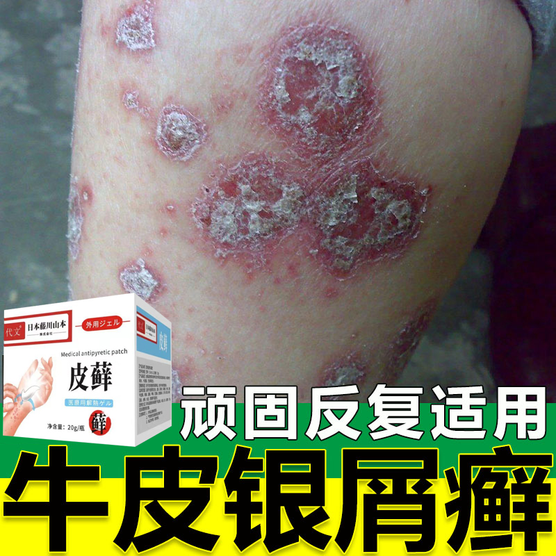 银屑真菌感染治可搭膏药贴牛皮鲜藓皮肤止痒抑菌湿疹根体癣去癣zq