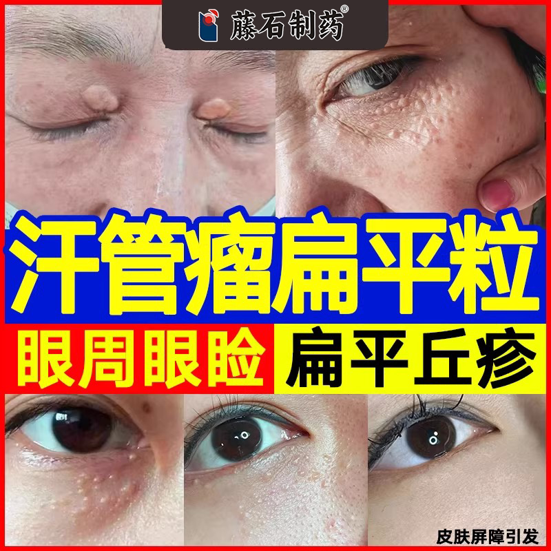 汗管瘤眼部眼角脂肪粒扁平疣睑黄瘤专搭去用除药监神备案器膏xj