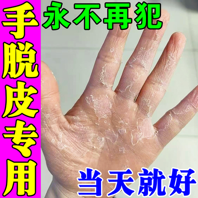 儿童手脱皮专用药膏治疗手掌手指严重蜕皮干燥起皮真菌感染修复霜