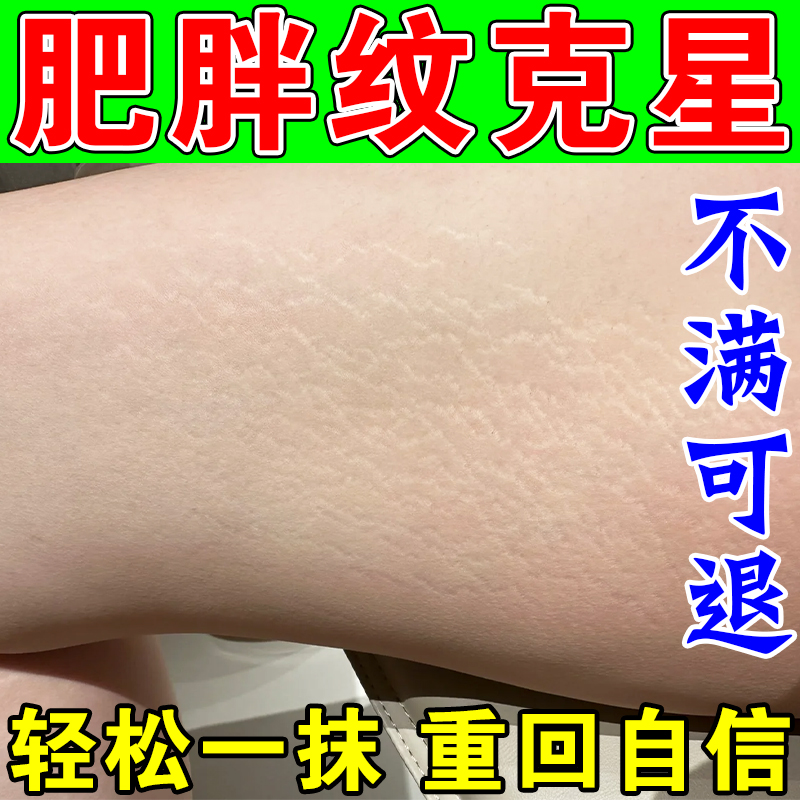 去除腿上肥胖纹生长纹修复霜消除学生大腿全身肥胖纹路淡化修复膏
