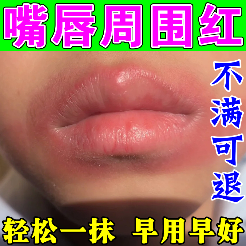 小孩嘴巴周围一圈红儿童舔嘴唇干裂脱皮干燥起皮红肿唇炎专用唇膏