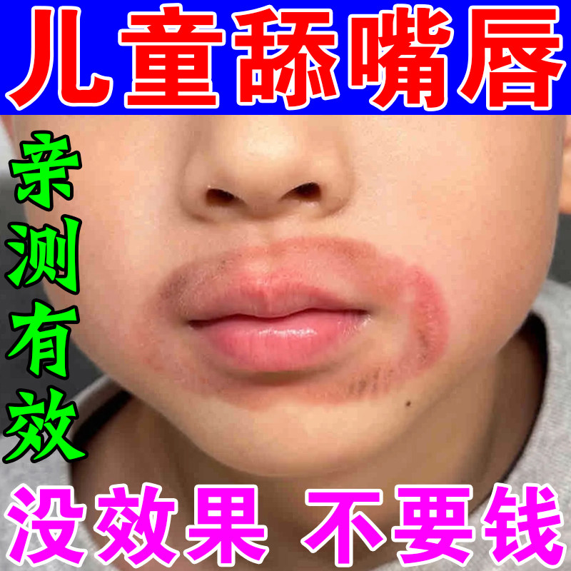 儿童舔嘴唇小孩嘴巴一圈红痒去羊胡子疮红肿干裂脱皮干燥起皮唇膏