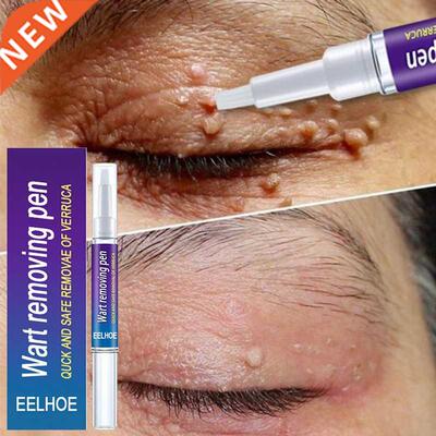 Wart Removal Mole Remedy Liquid Pen reatment Papillomas Remo