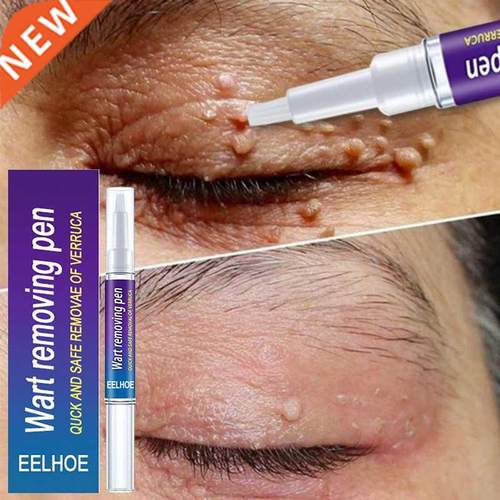 Wart Removal Mole Remedy Liquid Pen reatment Papillomas Remo