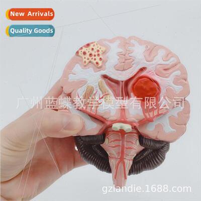 Human Brain Disease Brain Anatomy Neurosurgery Brain Patholo