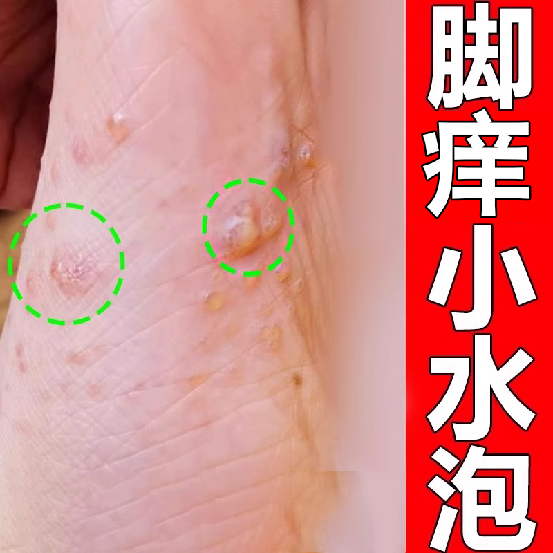 脚底上起小水泡又痒又脱皮脚痒掉皮脚丫痒脚脱皮痒喷雾