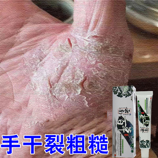 手蜕皮干燥起皮干裂粗糙手上起皮屑掉皮手裂口子外用软膏药
