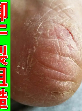 脚干裂粗糙干燥脚跟开裂秋冬天足底裂口子脚蜕皮脚后跟干裂修复霜