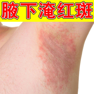 腋窝出汗多淹了红肿痛夏天天气热防腋下胳肢窝淹红有异味软膏