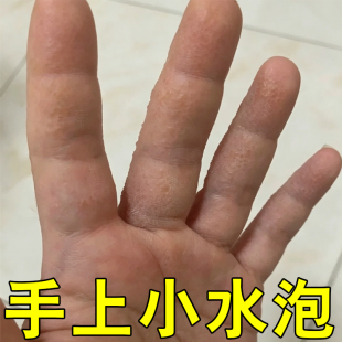 手上小水泡痒接触性感染手痒脱皮换季手指头上长小疙瘩粗糙痒软膏