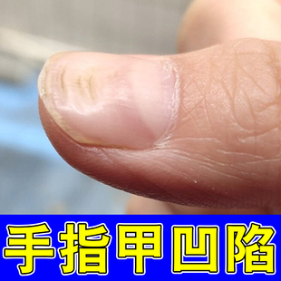 专冶受损指甲凹陷变形坑洼凹凸不平萎缩开裂分层手指脚趾甲修复液