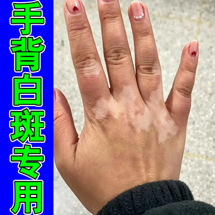 手背长白斑儿童成人肤色不均色素脱失补骨脂酊促进黑色素生长