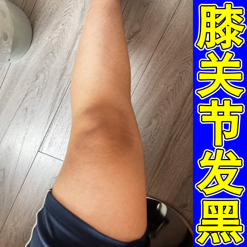 膝关节发黑外用修复皮肤黑色素沉皮肤消毒护理（消）