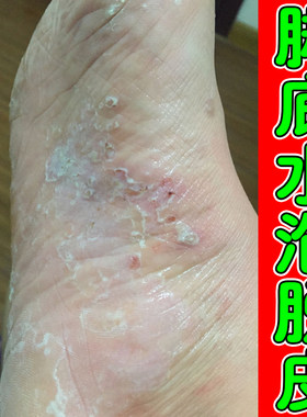 脚底上起小水泡又痒又脱皮脚痒掉皮烂脚丫脚痒脚长水泡痒