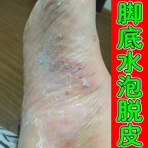 脚底上起小水泡又痒又脱皮脚痒掉皮烂脚丫脚痒脚长水泡痒