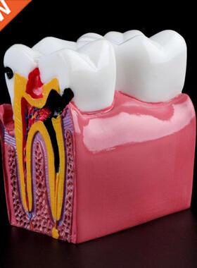 6 Times Dental Caries Comparation Anatomy Teeth Model for De