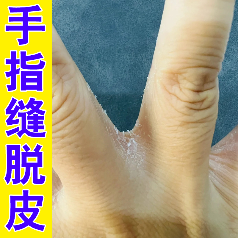 手指缝脱皮起干皮开裂红肿掉皮秋冬干燥专用