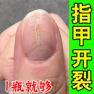 指甲裂纹甲床分离空甲修复液坏甲手脚指甲受损中间裂开竖纹修复油