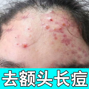 去额头痘痘闭口粉刺儿童成人脸上逆光疹红肿疙瘩硬块脓包熬夜上火