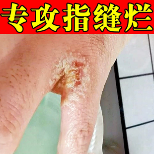手指缝溃烂指间烂经常碰水指缝烂手丫烂开裂发红脱皮流脓