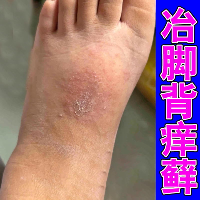 脚背痒脚背长红斑红点脚趾头上长脱屑起皮脚面干燥脱皮用软膏