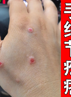 手上起结节疙瘩小红点刺挠越挠越痒红肿溃烂结痂起皮结节专用软膏