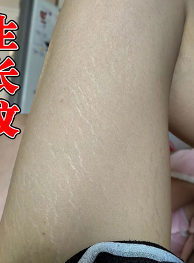 肥胖纹去除修复霜生长纹大腿学生腰腹部淡化纹路去肥胖纹专用
