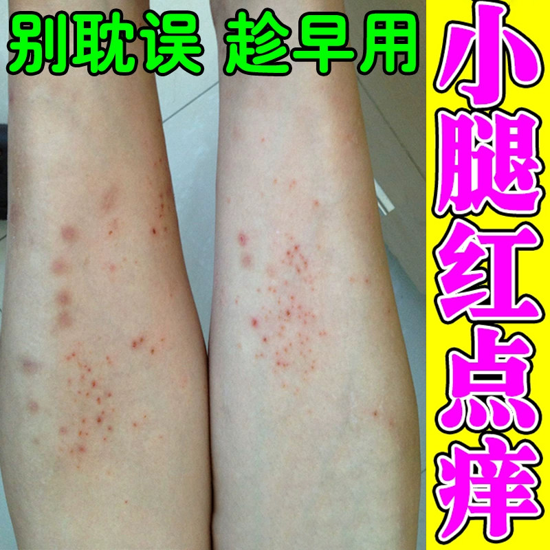 冬天小腿膏身上干燥起红疙瘩长小红点起皮脱屑过敏外用,保健用品,皮肤消毒护理（消）,淘宝优惠券,粉丝福利购,淘宝优惠卷