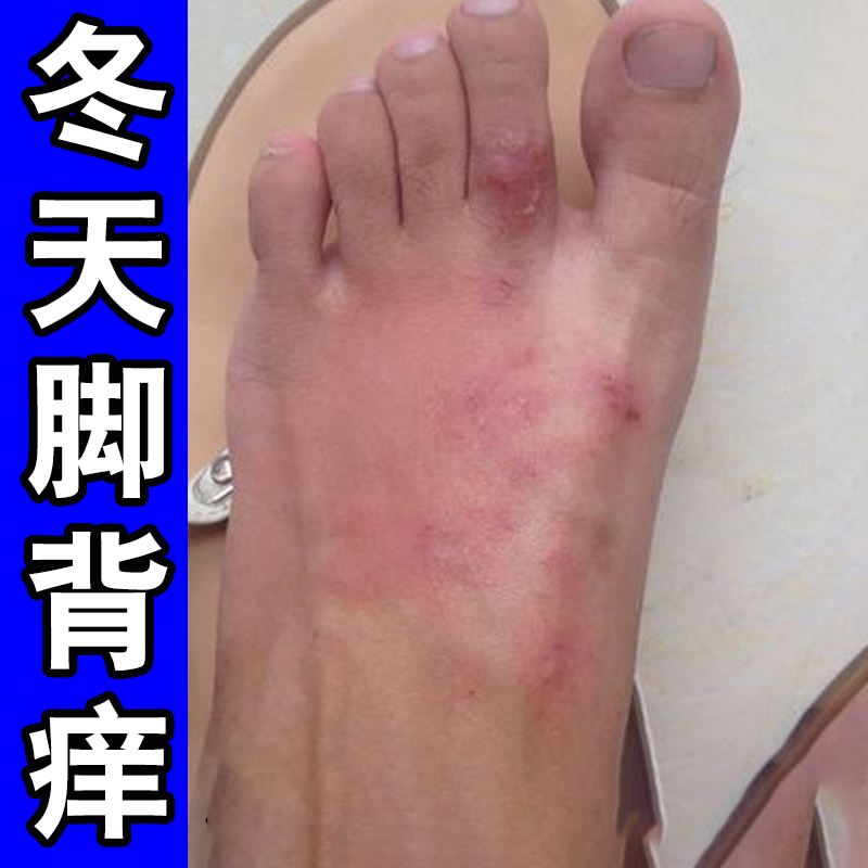 冶疗脚背痒脚面痒长红点脚趾头上长脱屑皮肤痒红肿专用软膏