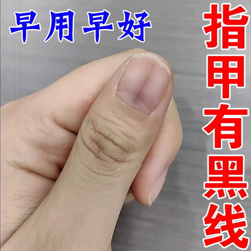 指甲有黑线指甲甲母痣指甲竖纹黑线分层修复灰指甲瘀血专用营养油