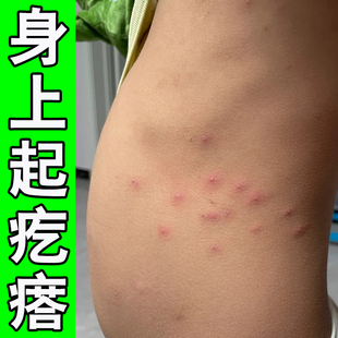 身上起红疙瘩手臂长小红点全身疙瘩红红斑软膏