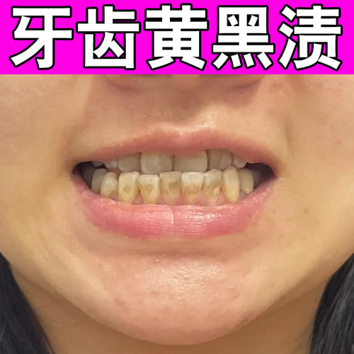 牙斑净牙缝发黑清理牙齿缝隙黑牙齿黑线黑渍牙窝沟牙菌斑