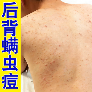 背上长豆豆螨虫后背有小疙瘩螨痒马拉色菌毛囊