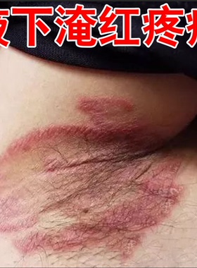 腋毛腋下红肿起小疙瘩出汗有味出汗发臭红斑胳肢窝淹专用膏