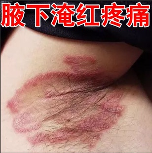 腋毛腋下红肿起小疙瘩出汗有味出汗发臭红斑胳肢窝淹专用膏