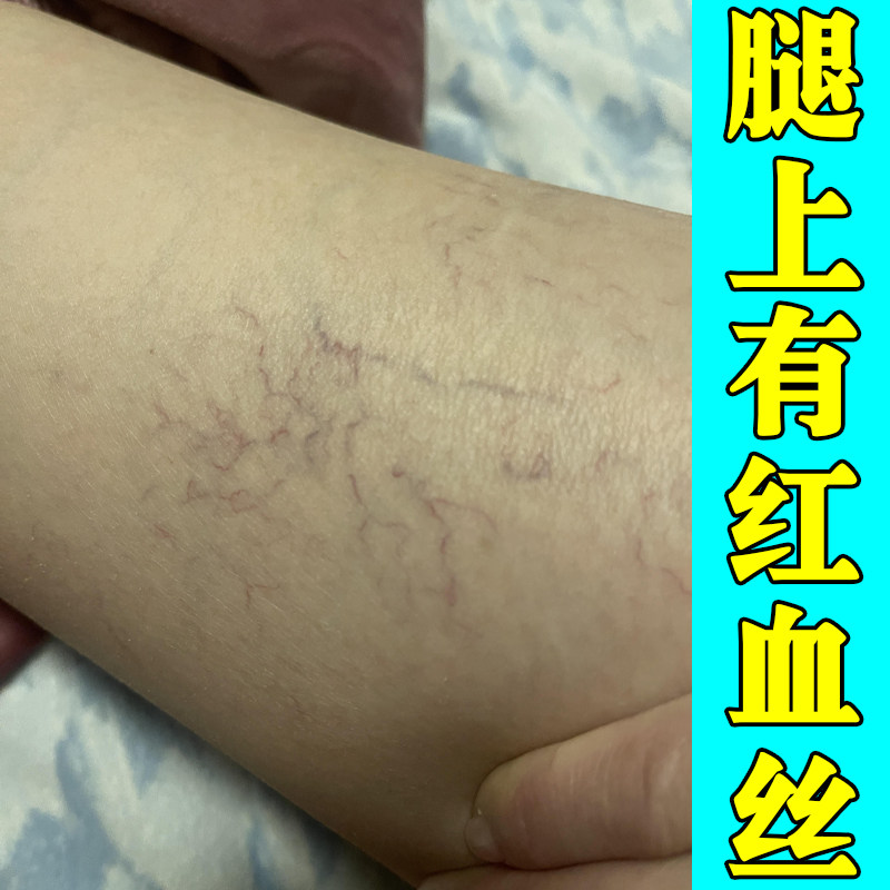 腿上有红血丝毛细血管扩张堵塞去皮肤消毒护理（消）