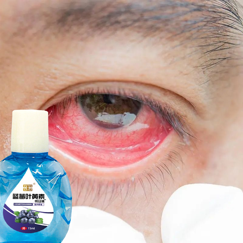 眼睛红血丝流泪结膜炎眼睛充血红肿干涩眼疲劳眼球充血眼红滴眼液