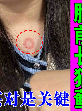 铜钱专用软膏冶疗猫人用皮肤痒真菌感染起红斑起皮宠净外用膏