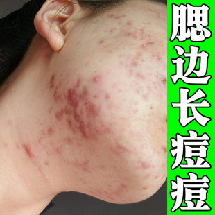 腮边长痘痘脸颊长红肿脓包痘熬夜上火腮帮子长痘脸上起痘外用乳膏