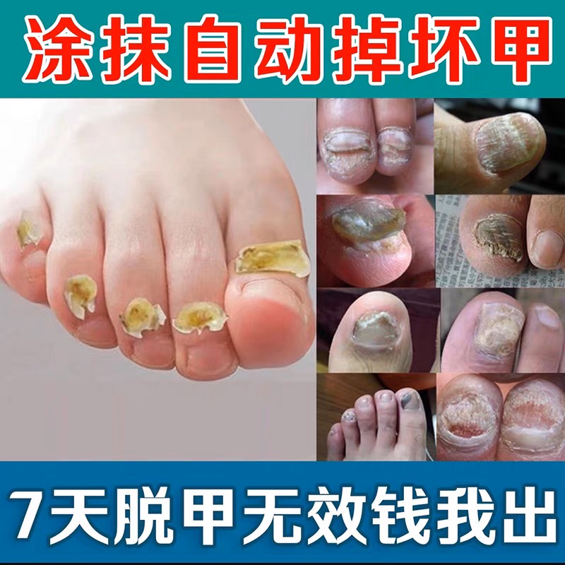 灰指甲无痛脱甲膏抑菌液草本甲沟炎快速脱甲精油嵌甲软化剂脚指甲