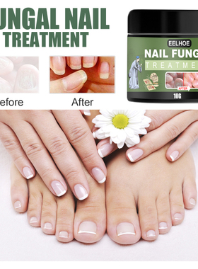 1pcs Nail Fungus Cream Onychomycosis Paronychia