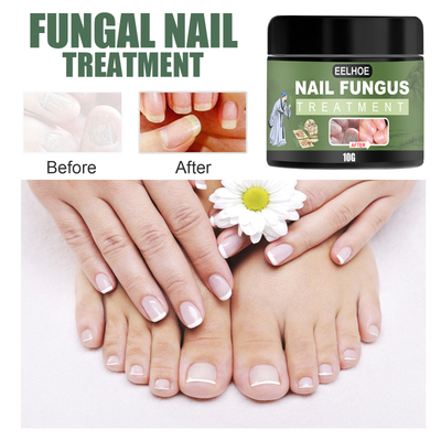 1pcs Nail Fungus Cream Onychomycosis Paronychia