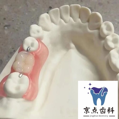 （先取模型）可拆卸临时牙假牙永久牙口腔修复隐形义齿活动牙牙套