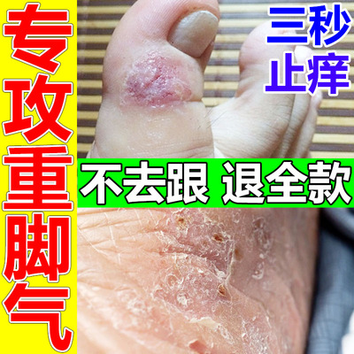 脚底上起小水泡又痒又脱皮脚丫子痒烂脚膏脚气水疱型止痒杀菌的药