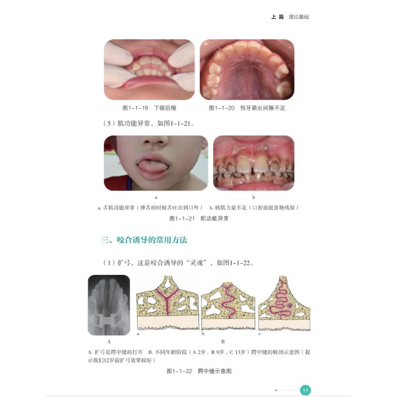 隐形咬合诱导病例集 口腔正畸临床病例参考 系统讲解隐形咬合诱导技术 真实案例图文并茂 作者出版社 9787572717727