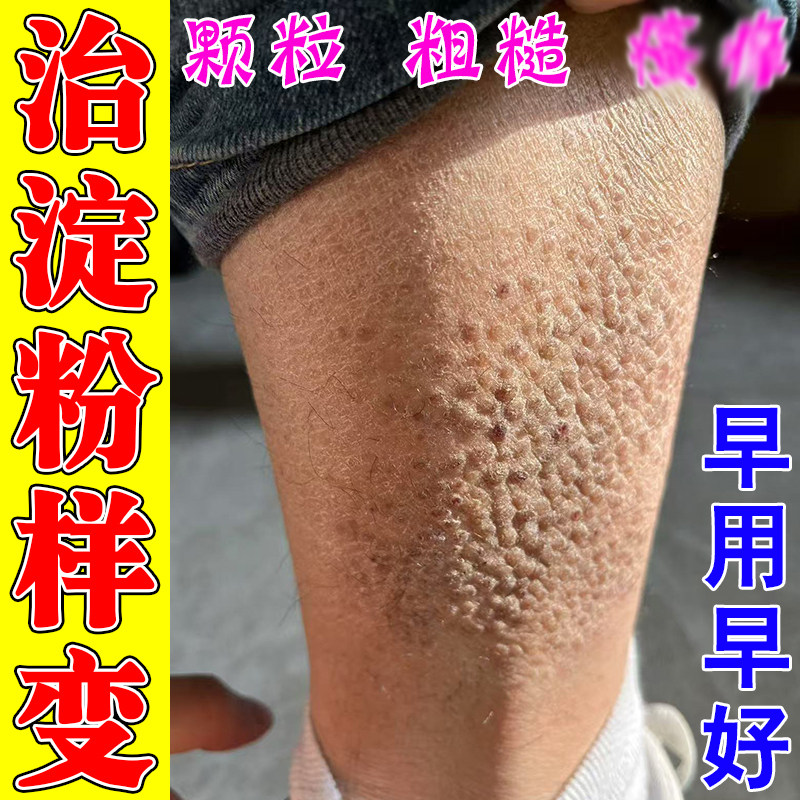 皮肤淀粉样变专用药治疗顽固皮鲜斑改善腿上皮肤粗糙小颗粒膏